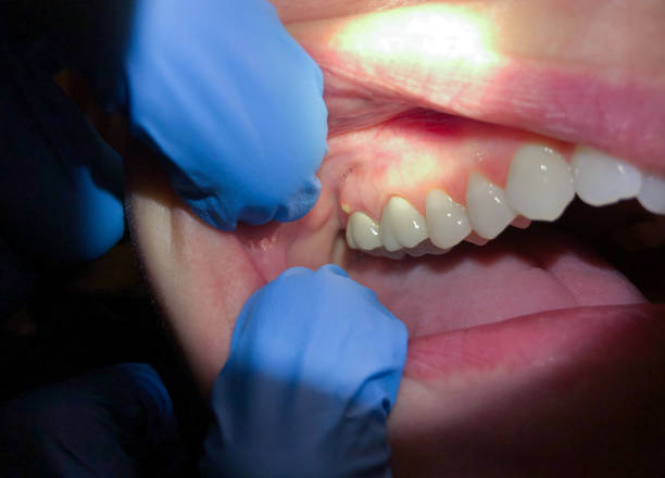 Best Emergency Dental Care for Abscessed Tooth in Landing, NJ